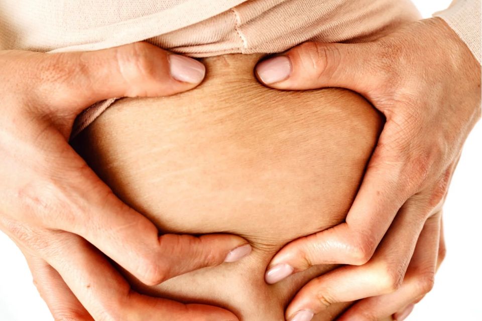 Stretch marks 101 what they are and how to treat them