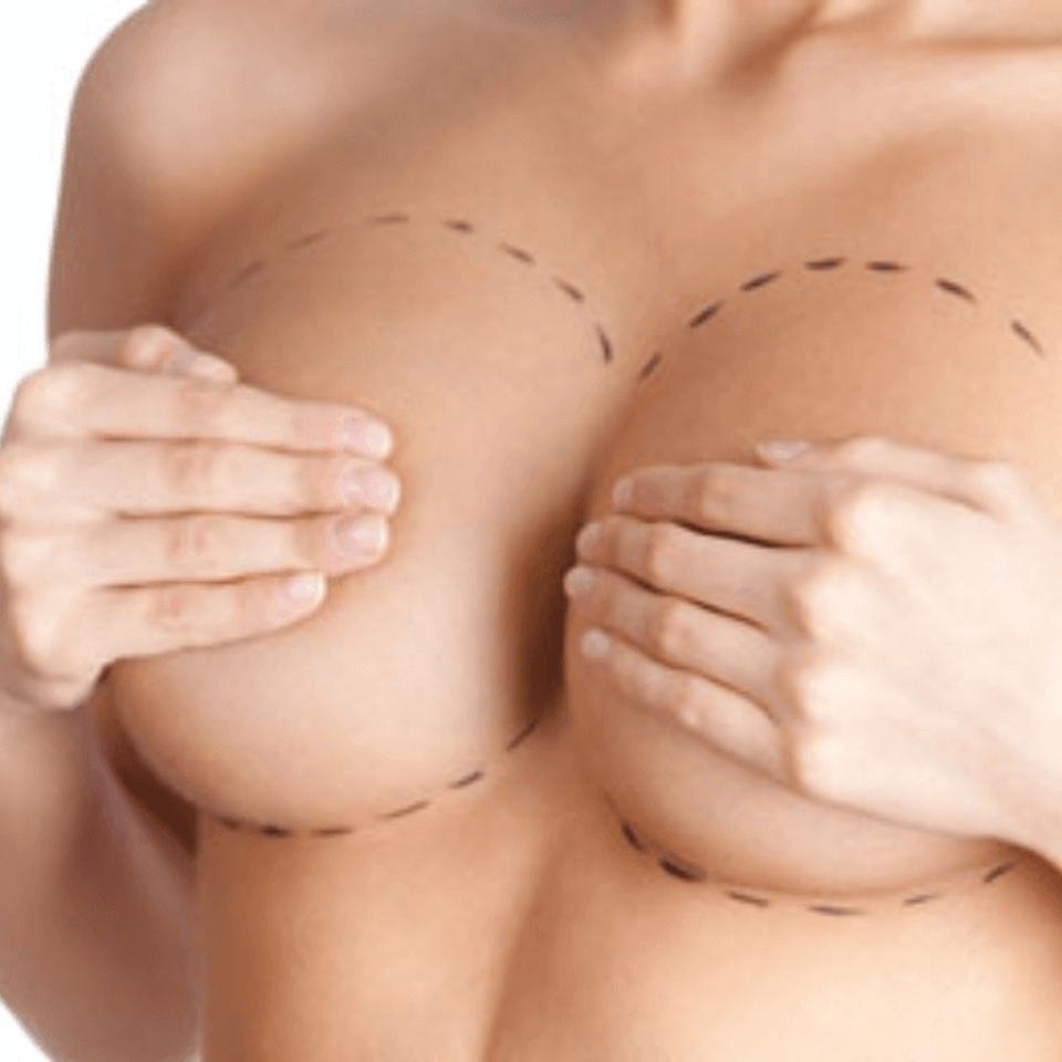 2 breast lift mastopexy tn