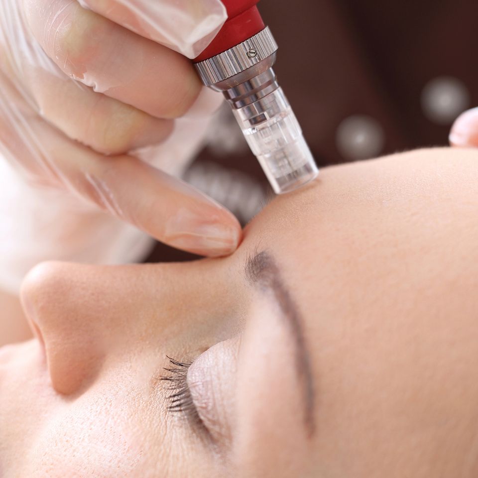 Microneedling lone pine dermatology