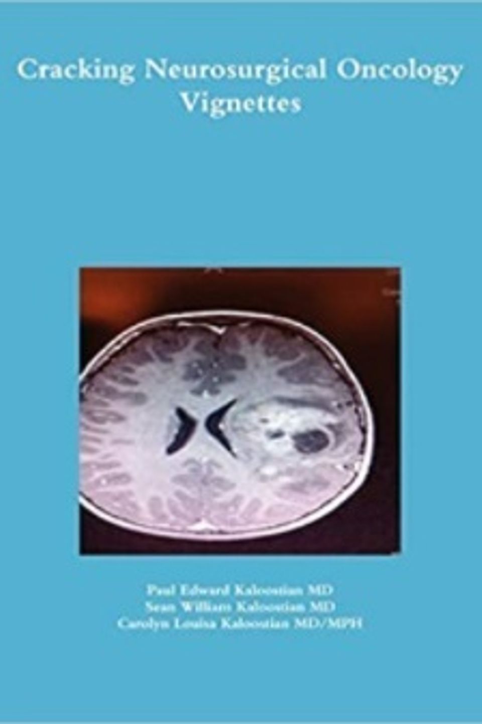 Cracking neurosurgical oncology vignettes