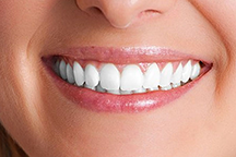 Teeth whitening in Nampa Idaho