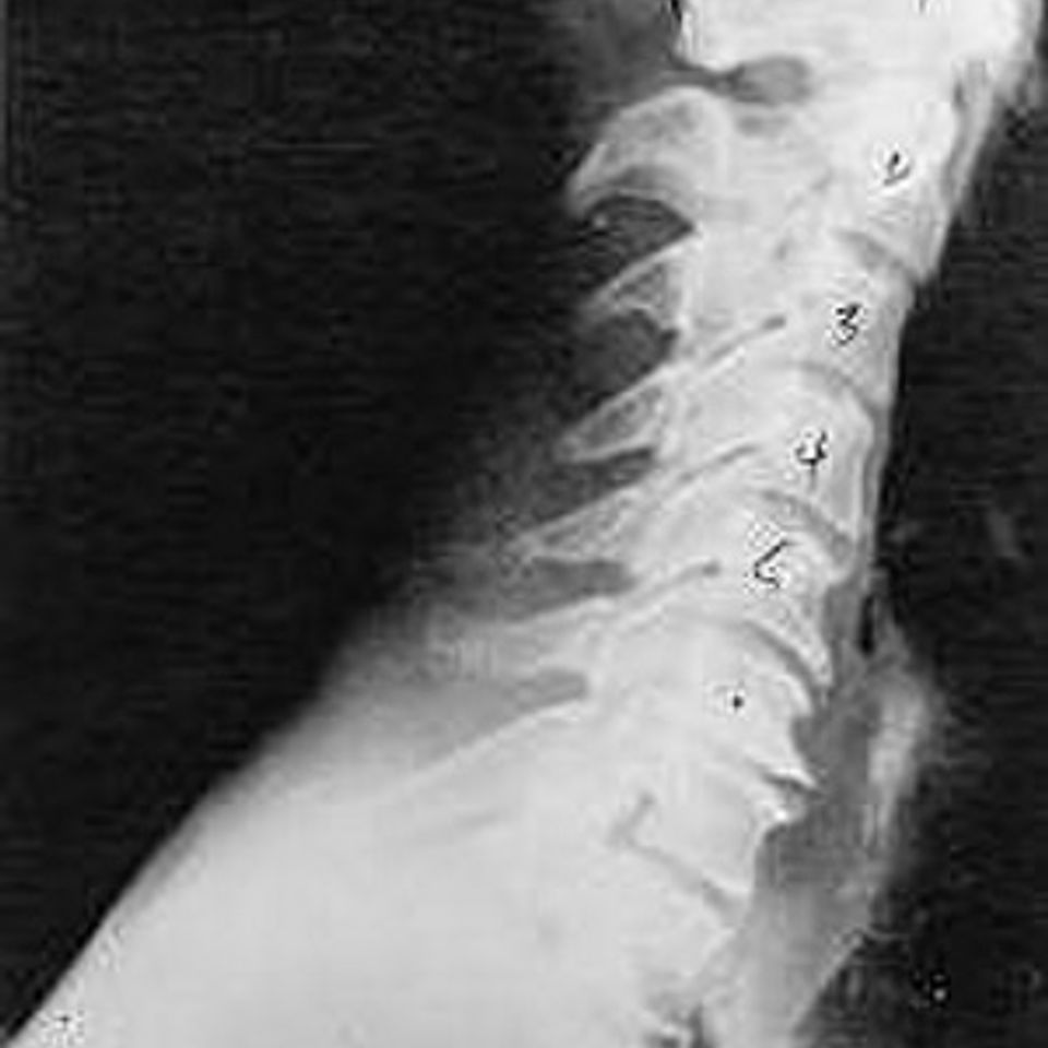 Subluxation phase three
