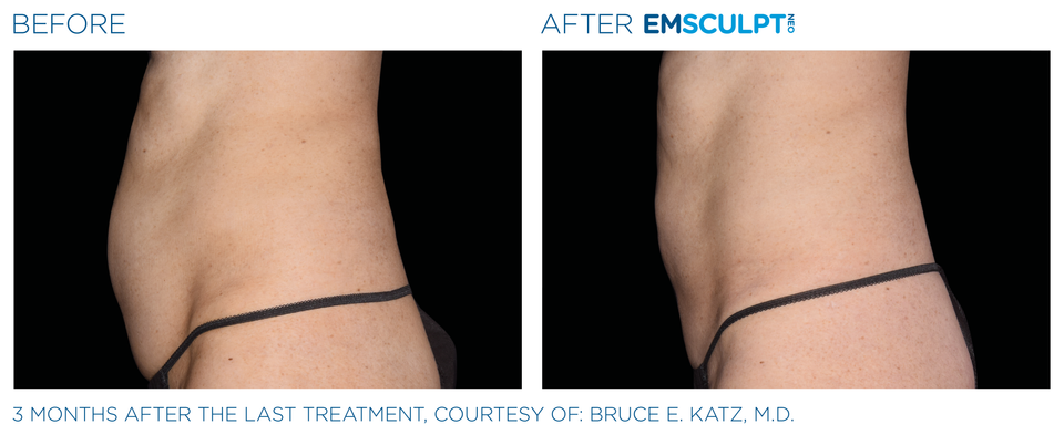 Emsculpt neo pic ba card female abdomen 006 enus100