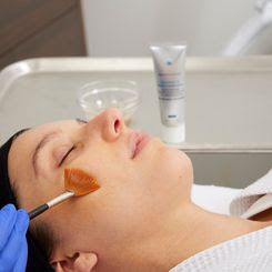 Treatment Chemical Peel