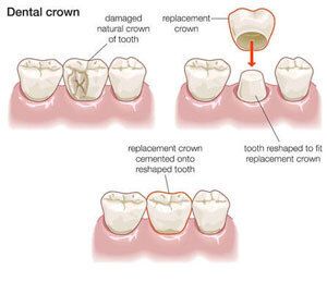 Meridian, Idaho Dental Crowns