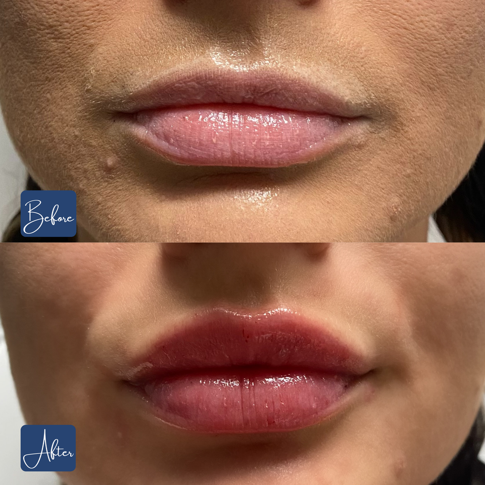 Lips 17