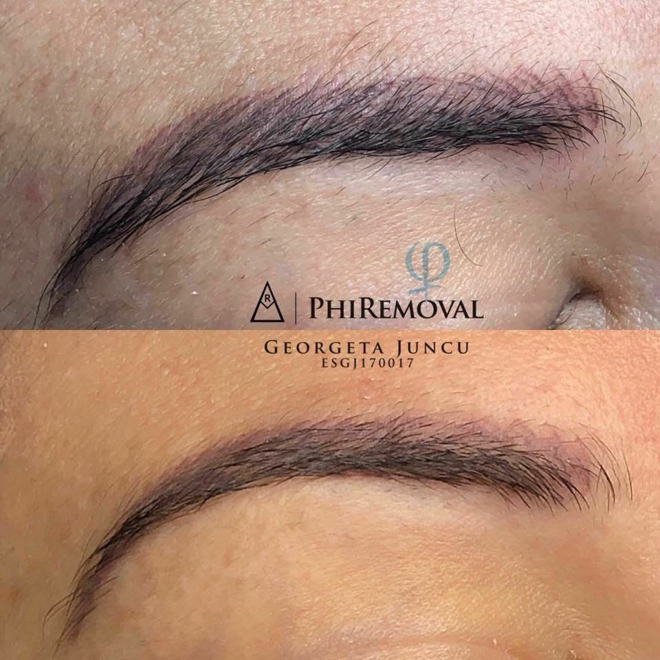 Phiremoval 5