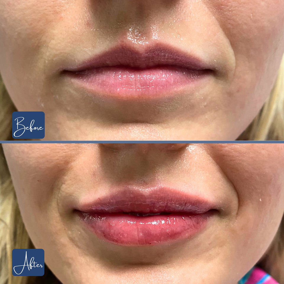 Lips 21
