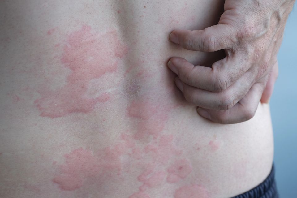 Close up image of skin texture potentially suffering from MCAS