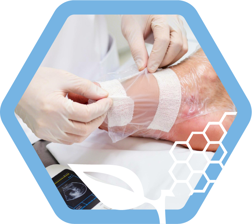 Nwc hex • negative pressure wound therapy