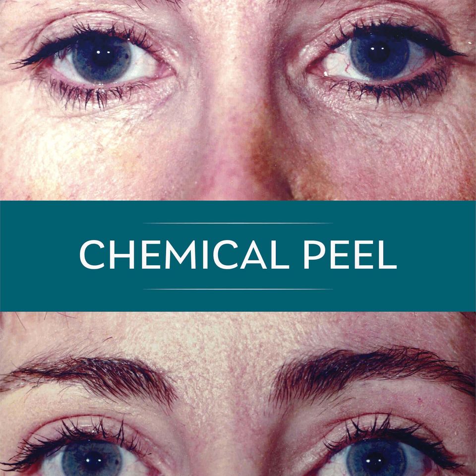 Nps social peel 03