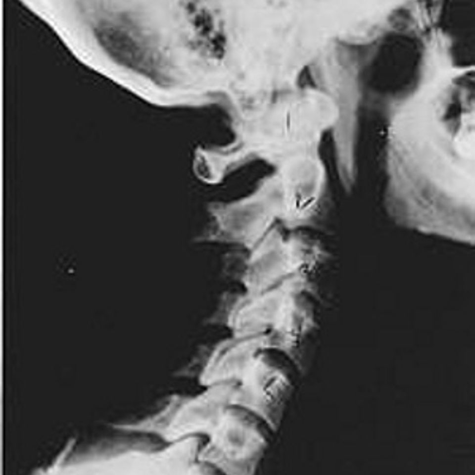 Subluxation near normal 1