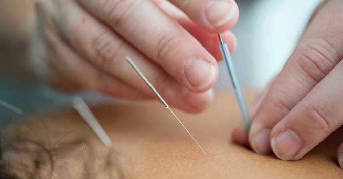 Trigger point dry needling