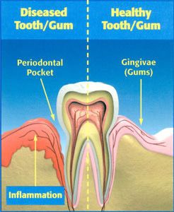 Gum Disease | Smileworks Meridian