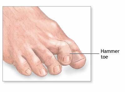 Hammertoe2