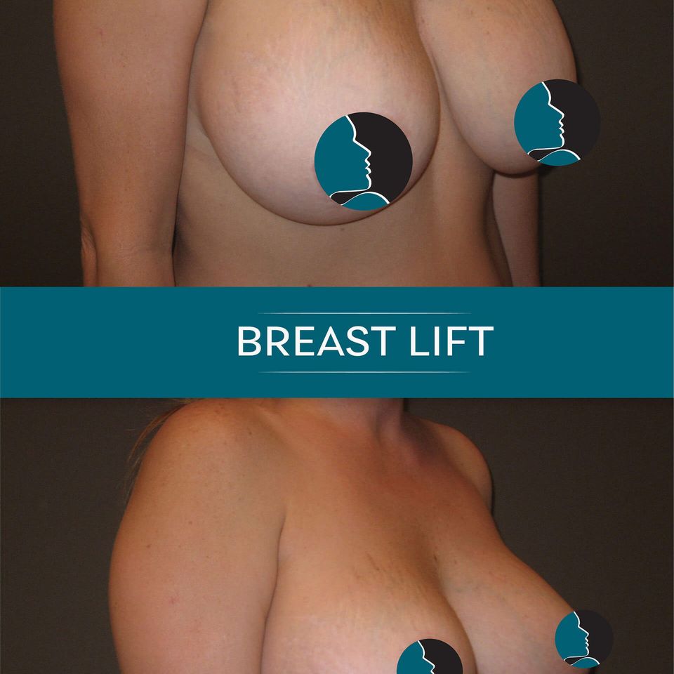 Nps social breasts lift 08