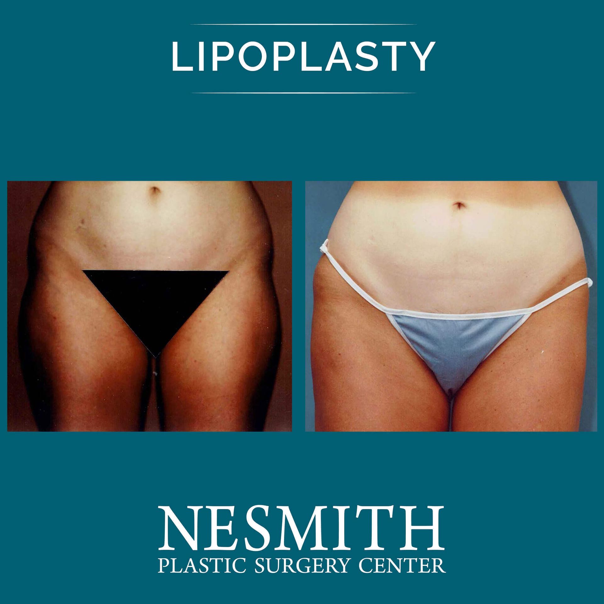 Nesmith Plastic Surgery Center 360 Lipo