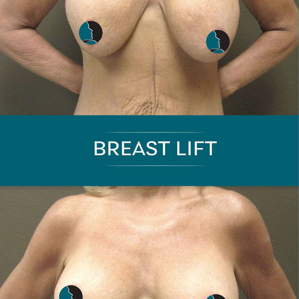 Nps social breasts lift 06
