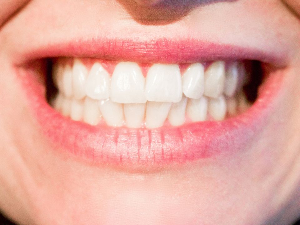 Teeth20170519 2252 77bvuf