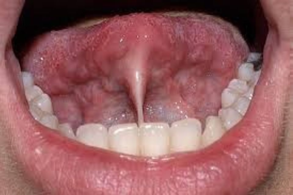 Ankyloglossia