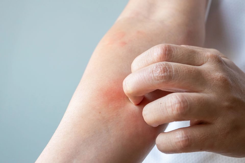 Close up shot of a man itching and scratching his arm, potentially due to mass cell activation syndrome
