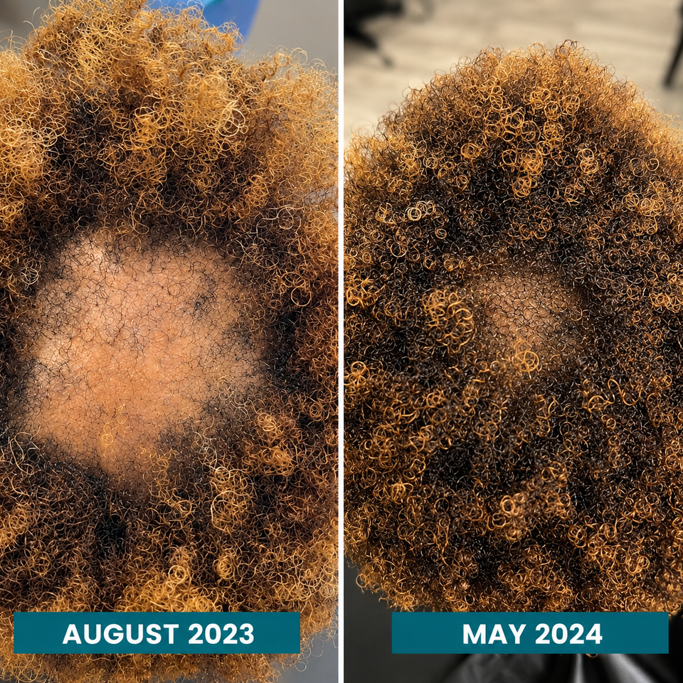 Ccca hair recovery client 4