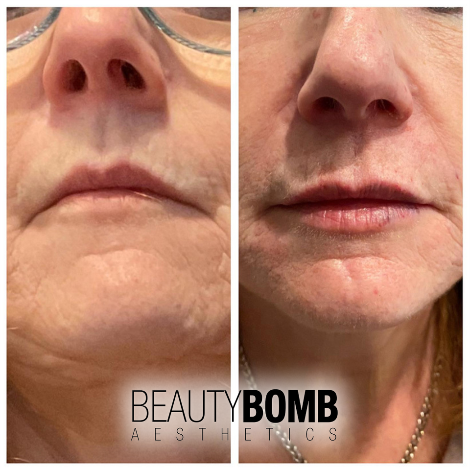Lip filler 2210 beautybomb aesthetics