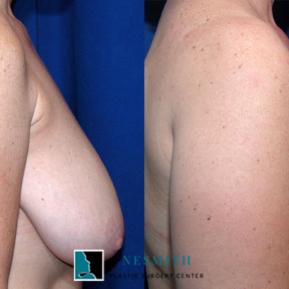 Breast reduction 1