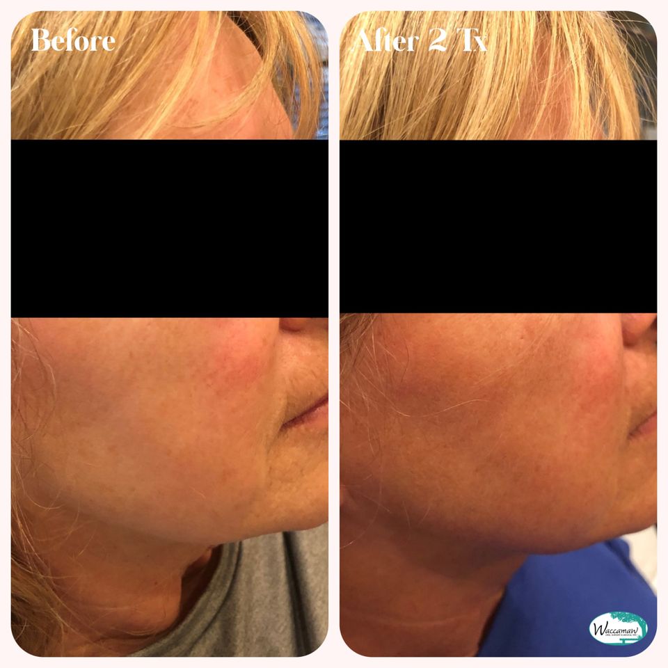 Microneedling 1