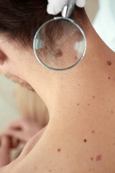 ABCDEs of An Atypical Mole