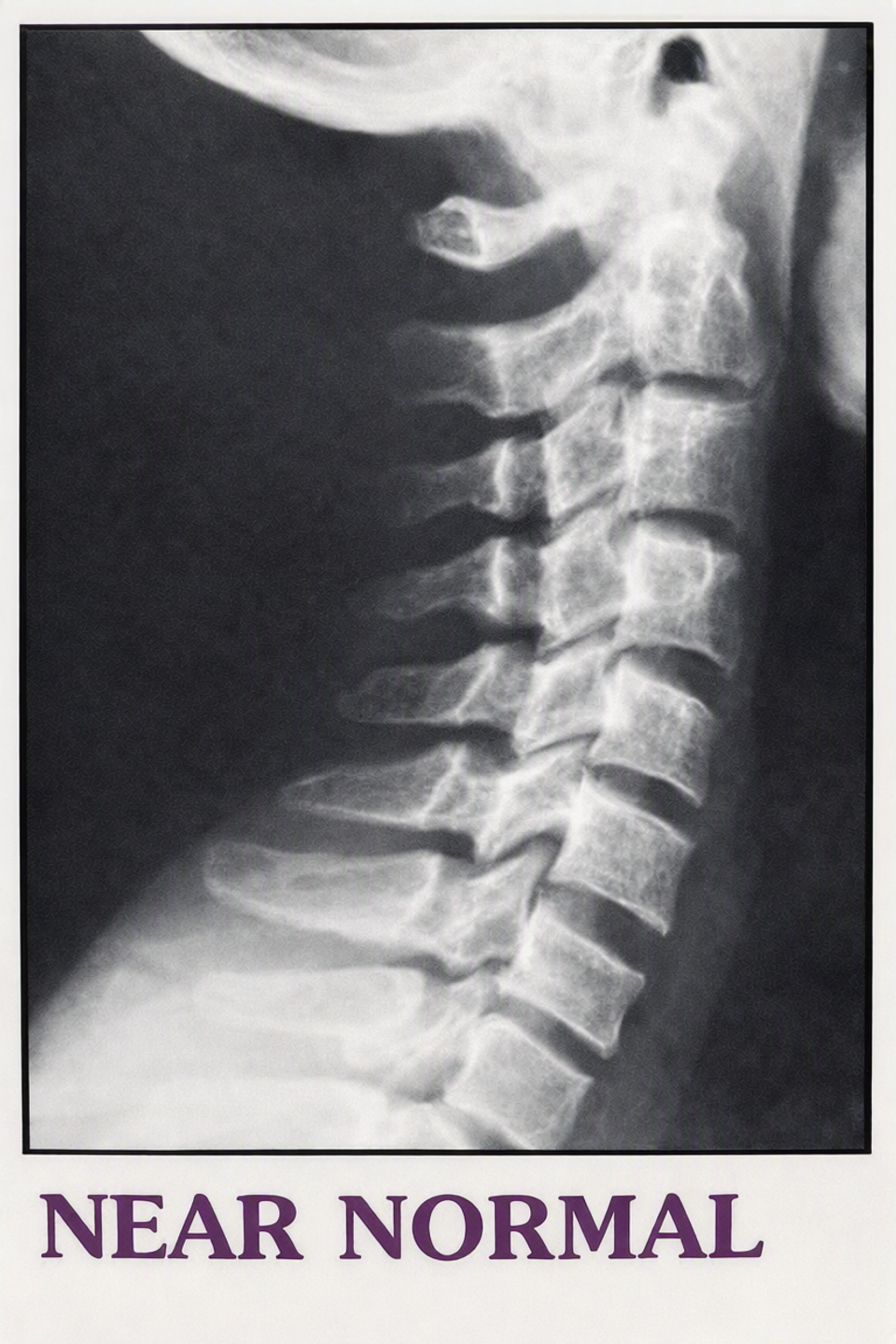 near normal upper cervical spine xray