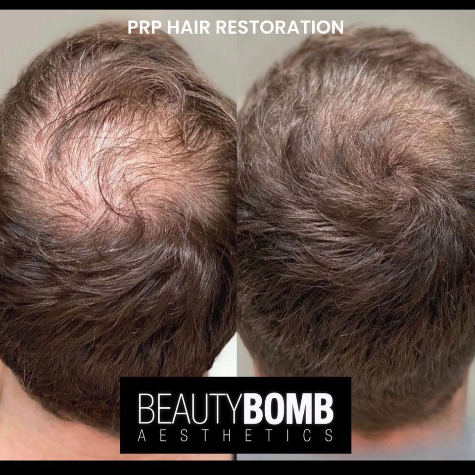 Hair restoration beauty bomb smithtown