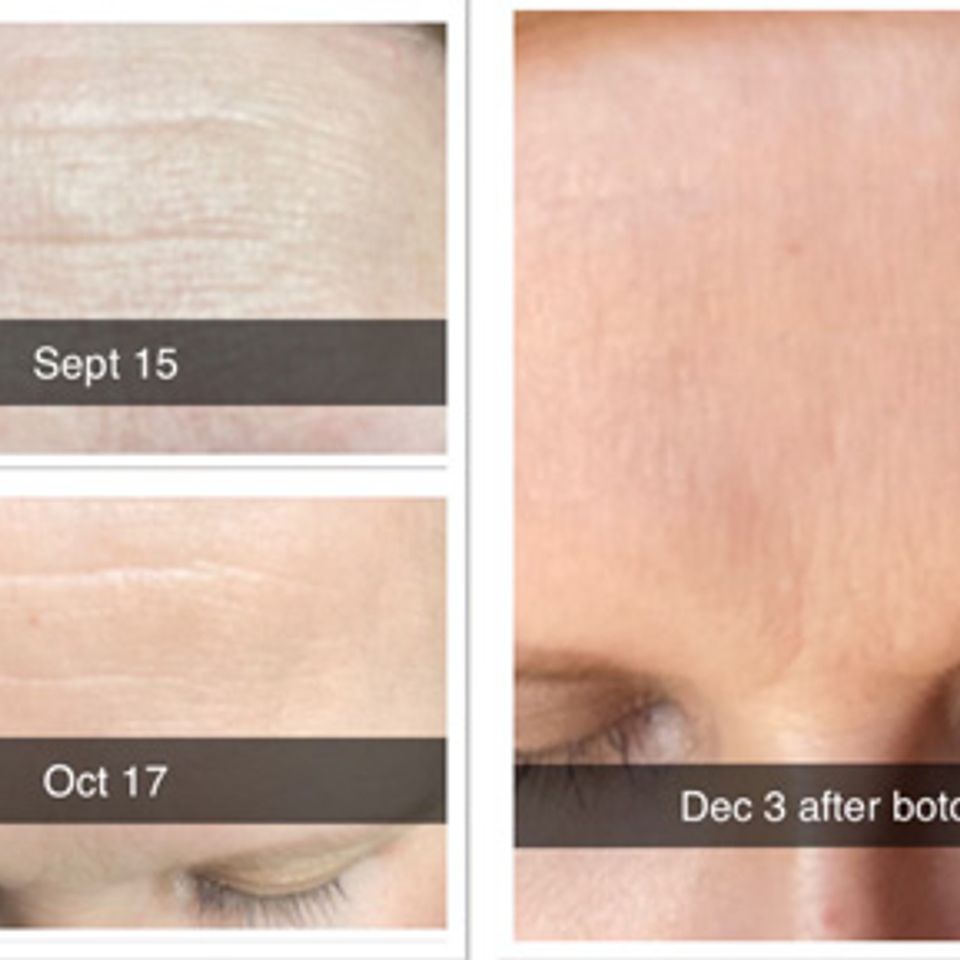 Rejuvatour botox