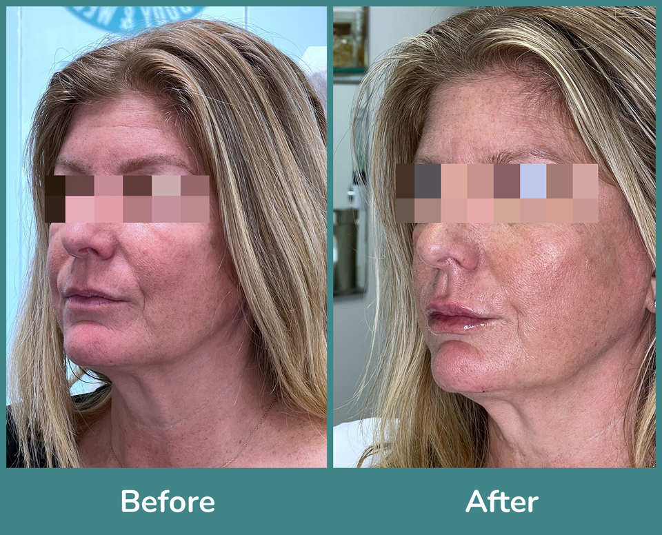 Before after 4