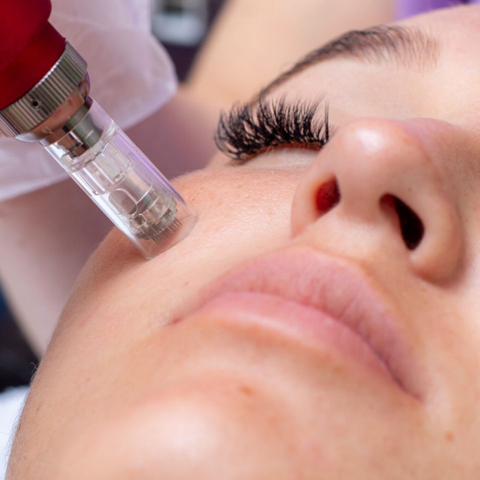 Professional microneedling treatment for smooth skin in the Roseville and Fair Oaks area.