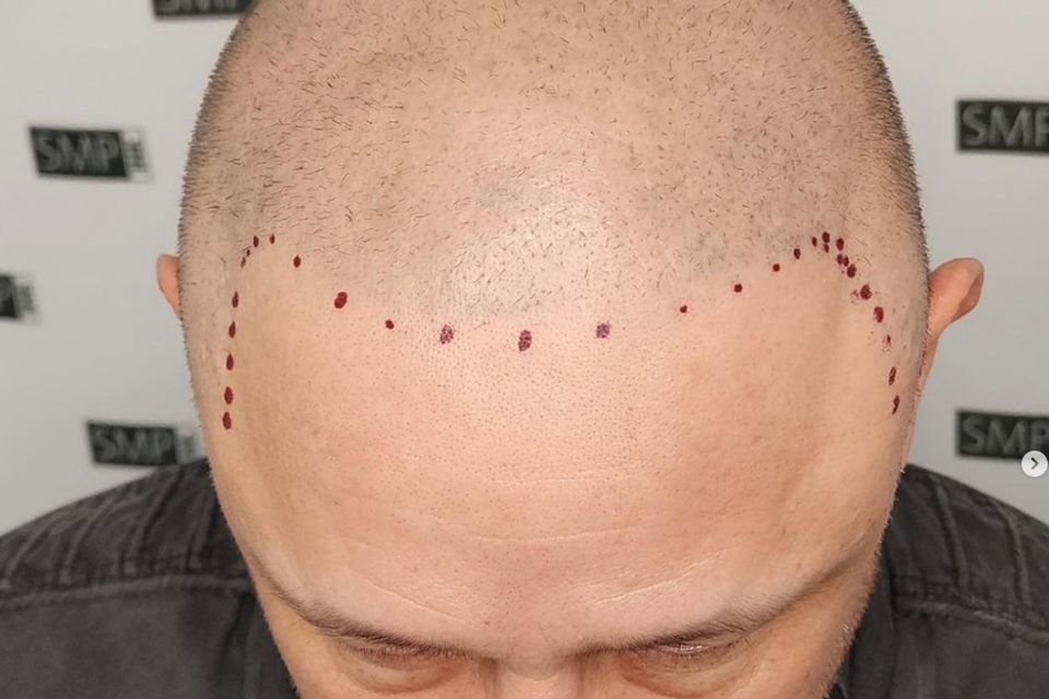 Scalp pugmentation