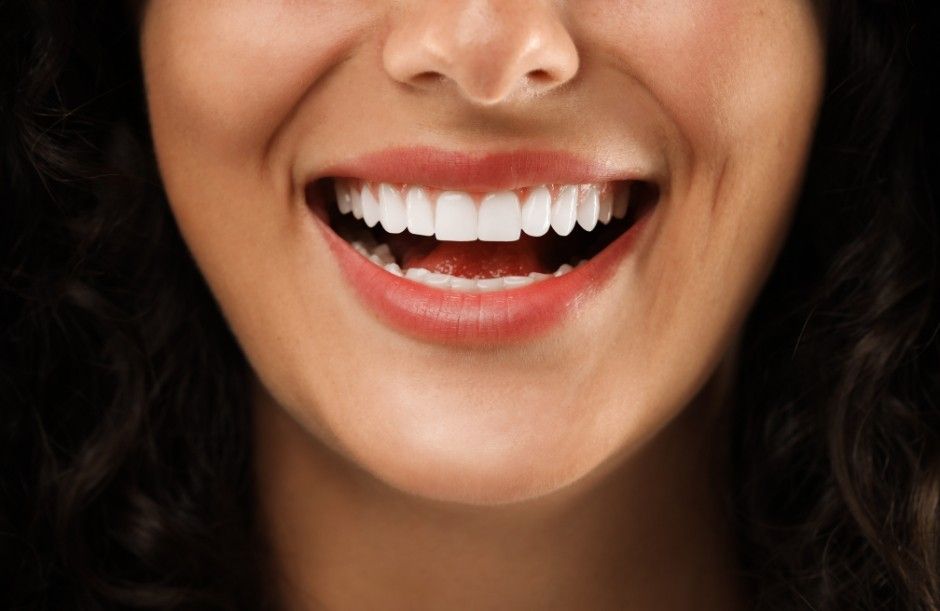 Veneer smile