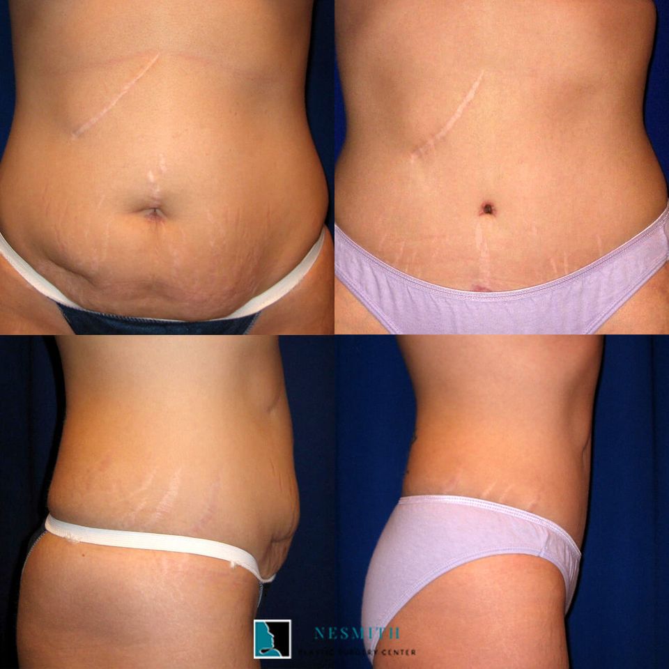 Tummy tuck body contouring 3