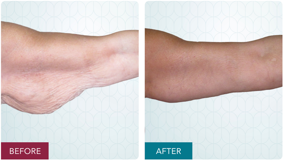 Case 2 brachioplasty