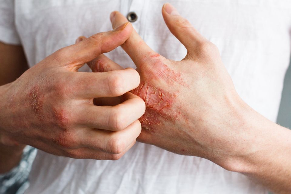 Winter Eczema Image