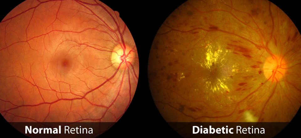 Diabetic retina