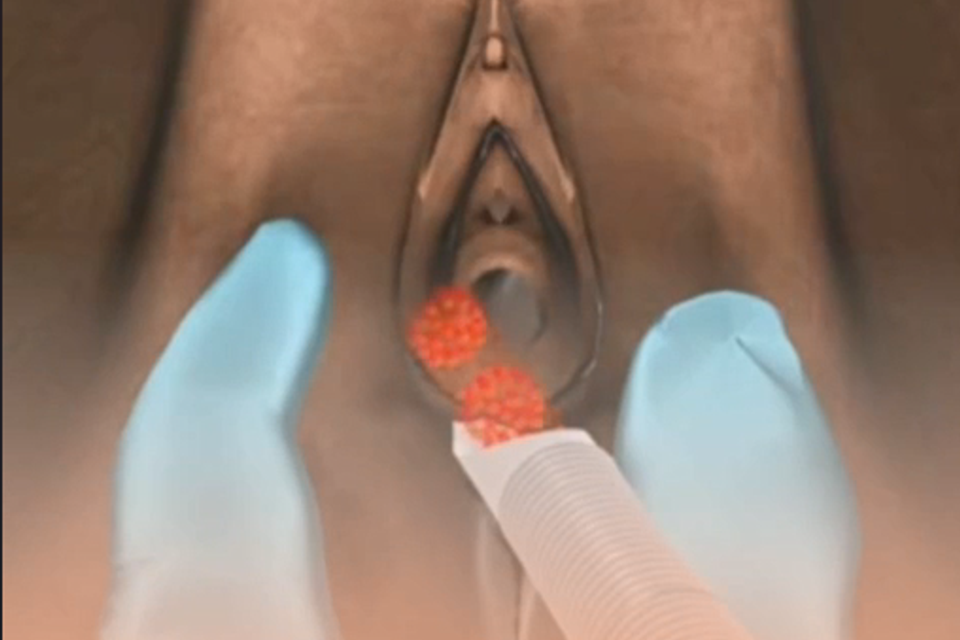 Vaginal rejuvenation 2