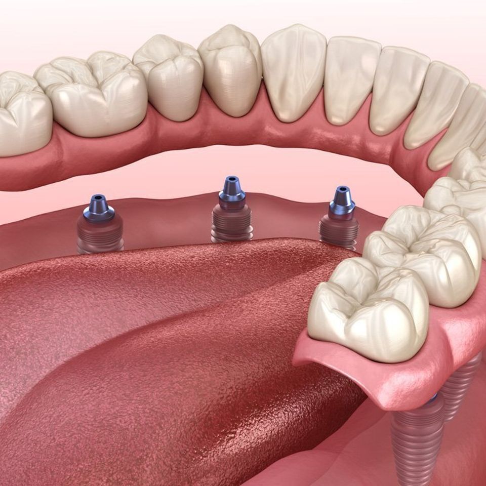 Visit the Dentist if You Have Symptoms Associated With Ill-Fitting Dentures  - Northside Dental Care, PC Peabody Massachusetts