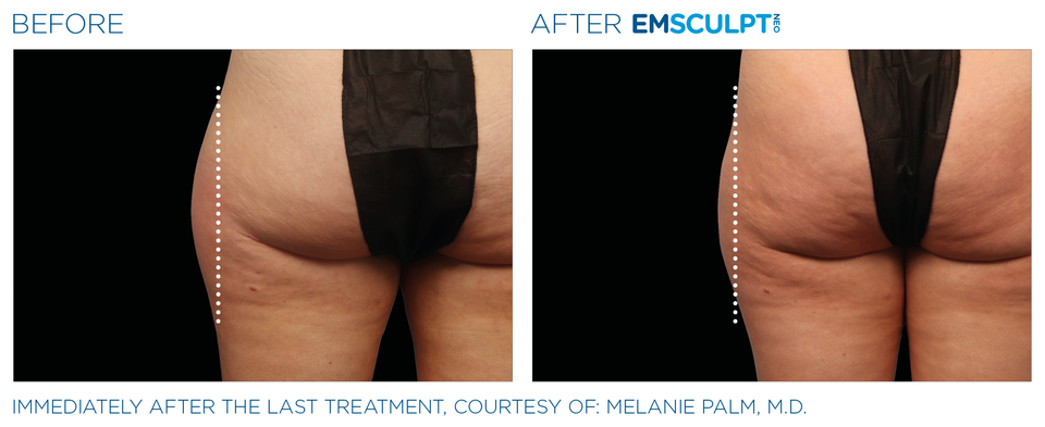 Emsculpt neo pic ba card female outer thighs 053 enus100