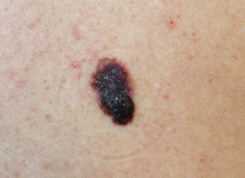 Melanoma image
