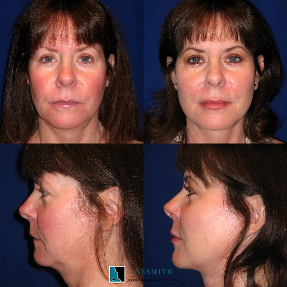 Facelift rhytidectomy 1