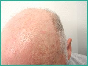 Baldness | nampa dermatologist