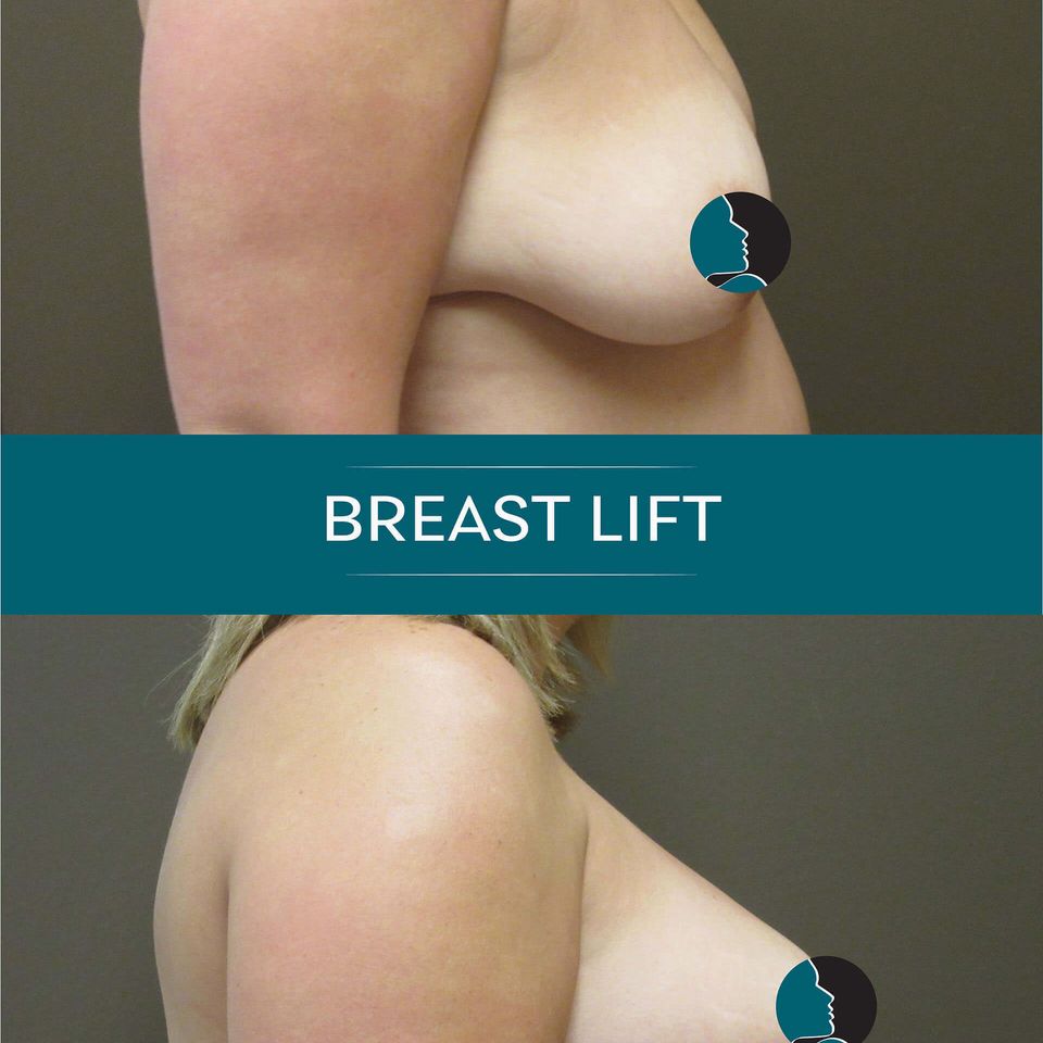 Nps social breasts lift 03