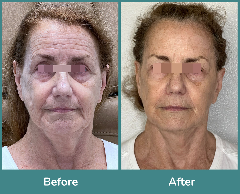 Before after 3