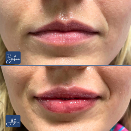 Lips 21